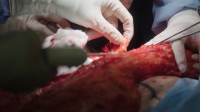 Botched Bariatrics S01E02 1080p WEB h264-FREQUENCY EZTV Botched Bariatrics S01E02 1080p WEB h264-FREQUENCY EZTV