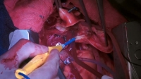 Surgeons At the Edge of Life S03E04 XviD-AFG EZTV Surgeons At the Edge of Life S03E04 XviD-AFG EZTV